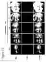 Fig. 04 - COMPOSITIONS COMPRISING A PROSTAGLANDIN FOR TREATING NEUROPSYCHIATRIC CONDITIONS