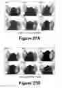 Fig. 15 - Molecular and herbal combinations for treating psoriasis