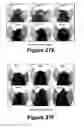Fig. 17 - Molecular and herbal combinations for treating psoriasis