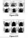 Fig. 17 - Molecular and herbal combinations for treating psoriasis