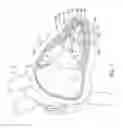 Fig. 02 - Delivery devices and methods for leadless cardiac devices