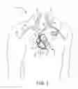 Fig. 02 - MRI COMPATIBLE TACHYCARDIA LEAD