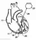 Fig. 01 - Pacemaker with detection of atrial activity without collection of atrial electrical activity