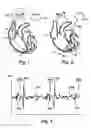 Fig. 02 - Pacemaker with detection of atrial activity without collection of atrial electrical activity