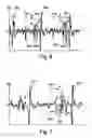 Fig. 05 - Pacemaker with detection of atrial activity without collection of atrial electrical activity