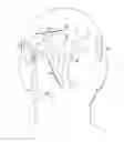 Fig. 01 - Implantable head located radiofrequency coupled neurostimulation system for head pain