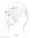 Fig. 07 - Implantable head located radiofrequency coupled neurostimulation system for head pain