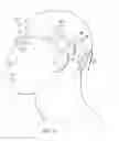 Fig. 08 - Implantable head located radiofrequency coupled neurostimulation system for head pain