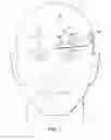 Fig. 09 - Implantable head located radiofrequency coupled neurostimulation system for head pain