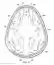 Fig. 35 - Implantable head located radiofrequency coupled neurostimulation system for head pain
