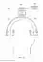 Fig. 33 - Implantable head located radiofrequency coupled neurostimulation system for head pain