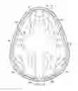 Fig. 34 - Implantable head located radiofrequency coupled neurostimulation system for head pain
