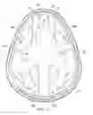 Fig. 35 - Implantable head located radiofrequency coupled neurostimulation system for head pain