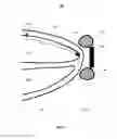 Fig. 02 - Local lead to improve energy efficiency in implantable wireless acoustic stimulators