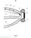 Fig. 06 - Local lead to improve energy efficiency in implantable wireless acoustic stimulators