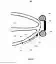 Fig. 07 - Local lead to improve energy efficiency in implantable wireless acoustic stimulators