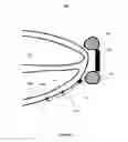 Fig. 08 - Local lead to improve energy efficiency in implantable wireless acoustic stimulators