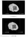 Fig. 08 - Methods, systems, and computer readable media for visualization of resection target during epilepsy surgery and for real time spatiotemporal visualization of neurophysiologic biomarkers