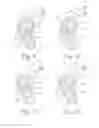 Fig. 04 - Wearable Device for the Ear with Electroencephalographic and Spectroscopic Sensors