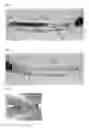 Fig. 04 - Method for approximating wounds