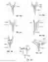 Fig. 15 - Tissue ligation devices and controls therefor