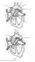 Fig. 07 - Devices and methods for treating patent ductus arteriosus