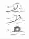 Fig. 02 - Devices and Methods for Occluding a Cerebral Aneurysm