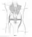 Fig. 05 - Quadriceps tendon stripper