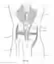 Fig. 07 - Quadriceps tendon stripper