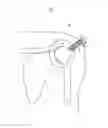 Fig. 02 - Method of providing for the minimization of extravasation during arthroscopic surgery