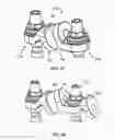 Fig. 28 - Flexible spine stabilization system