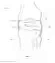 Fig. 02 - THERMALLY TREATING TORN TISSUE