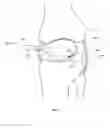 Fig. 05 - THERMALLY TREATING TORN TISSUE