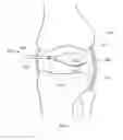 Fig. 06 - THERMALLY TREATING TORN TISSUE