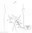 Fig. 01 - Ablation therapy to disrupt coordinated bladder contractions