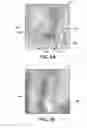 Fig. 03 - Ablation therapy to disrupt coordinated bladder contractions
