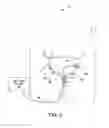 Fig. 04 - Ablation therapy to disrupt coordinated bladder contractions