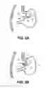 Fig. 03 - METHODS AND DEVICES FOR CREATING AN OPENING THROUGH AN ANATOMIC WALL