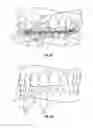 Fig. 10 - Method and apparatus for treating orthodontitis