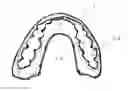 Fig. 01 - Orthodontic retainer