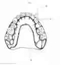 Fig. 04 - Orthodontic retainer