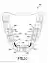 Fig. 12 - Dental arch and airway expander device and method