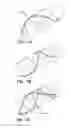 Fig. 05 - Intravascular device with multiple leaflets