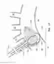 Fig. 15 - Intravascular device with multiple leaflets