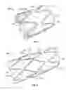 Fig. 05 - Intralumenal stent graft fixation