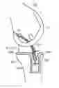 Fig. 01 - LIGAMENT FIXING AND A METHOD OF ATTACHING A LIGAMENT