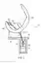 Fig. 03 - LIGAMENT FIXING AND A METHOD OF ATTACHING A LIGAMENT