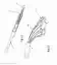 Fig. 10 - Heart valve repair and replacement