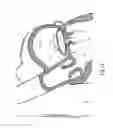 Fig. 11 - Heart valve repair and replacement