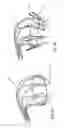 Fig. 15 - Heart valve repair and replacement